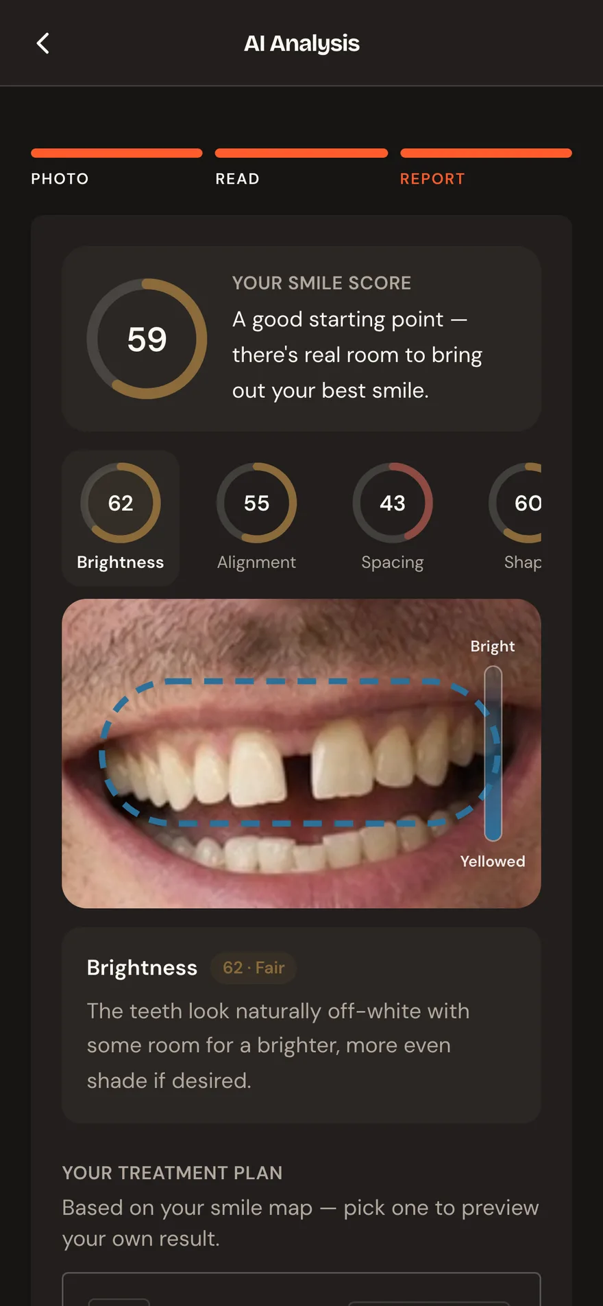 The smile analysis: a Smile Score with seven named indicators and the region outlined on the patient's own teeth